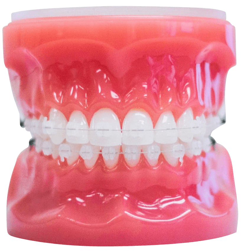 clear braces on plastic model